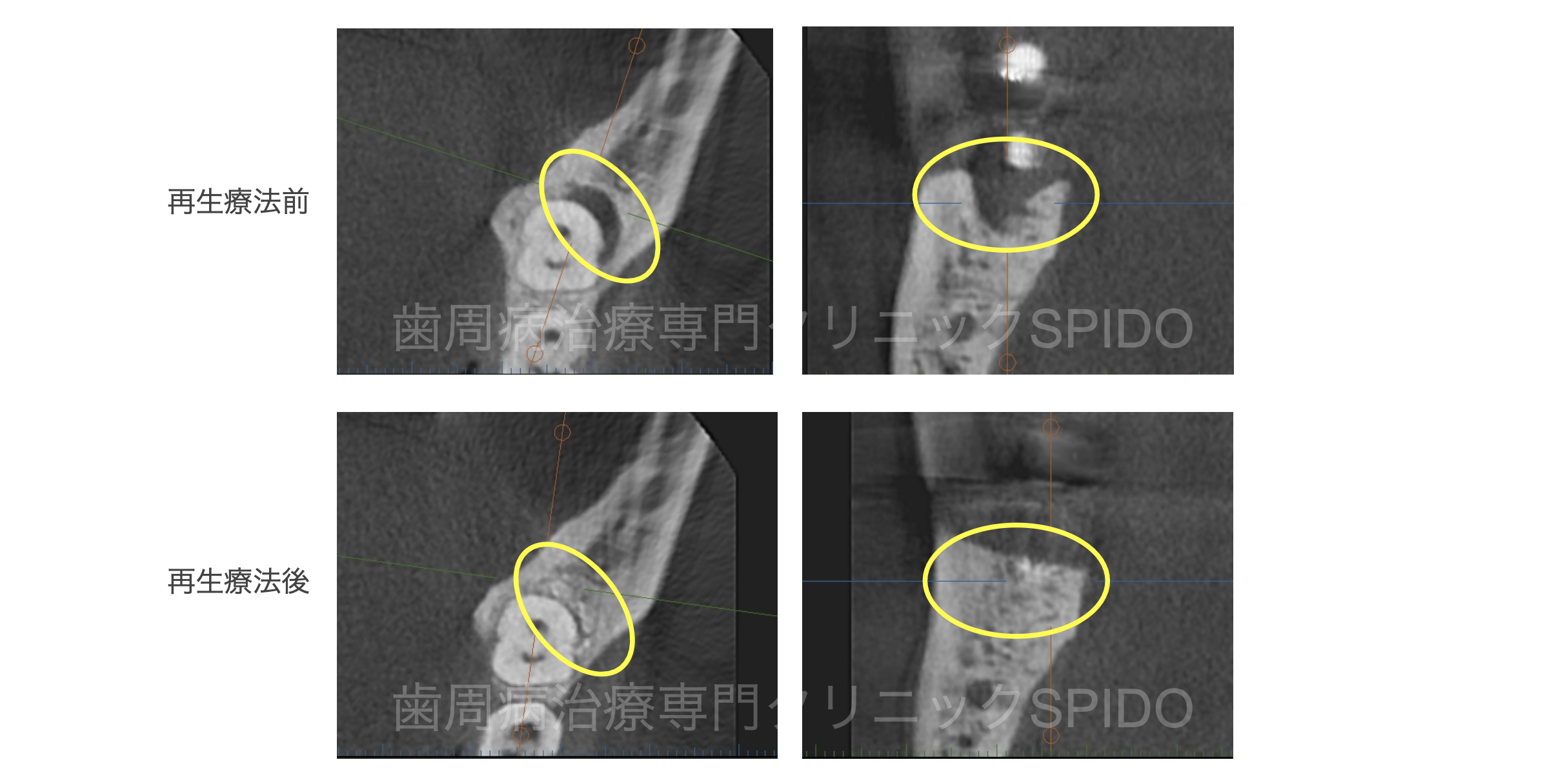 歯周組織再生療法を受けても良いクリニックの見極め方① -診断の